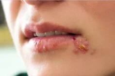 Asiviral Krem Nedir? Asiviral Krem Ne İşe Yarar?